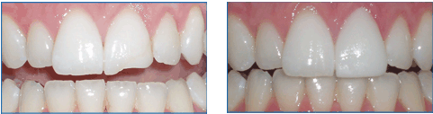 естетична реставрація зубів